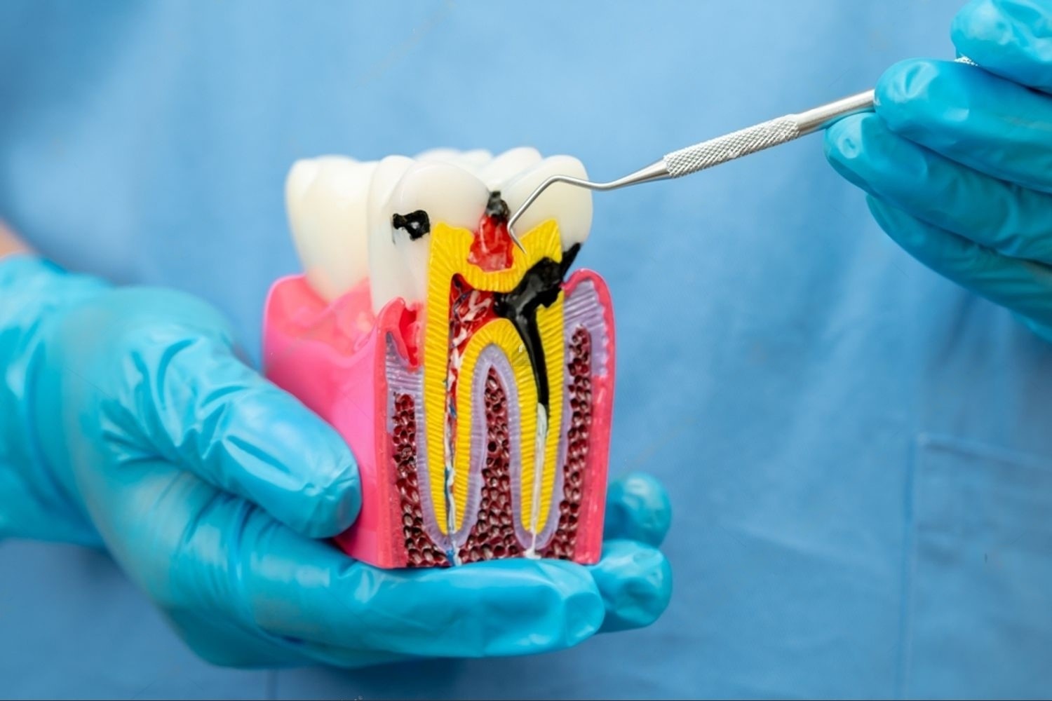 https://www.tooth-tastic.com/wp-content/uploads/2024/08/10-Root-Canal-Treatment.jpeg