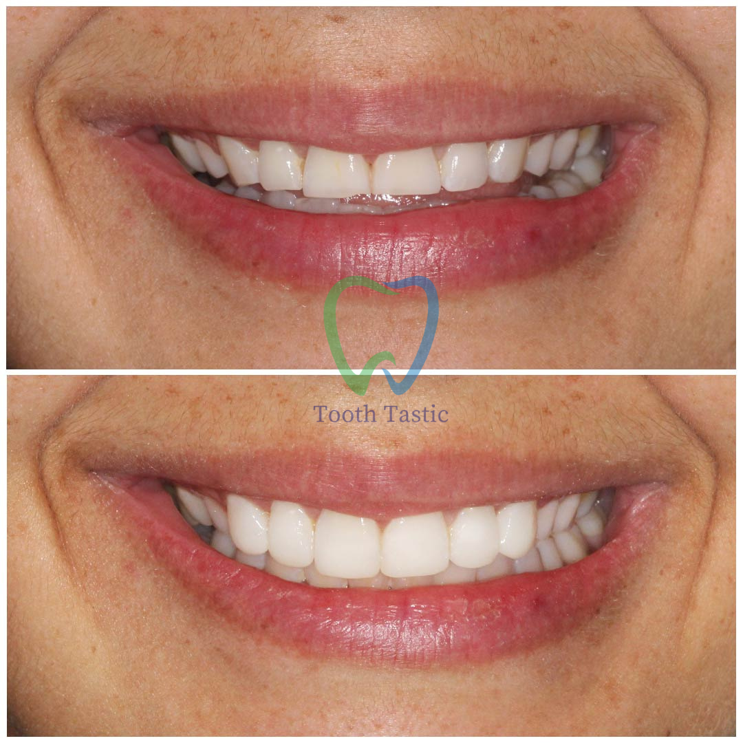 Smile makeover Dubai