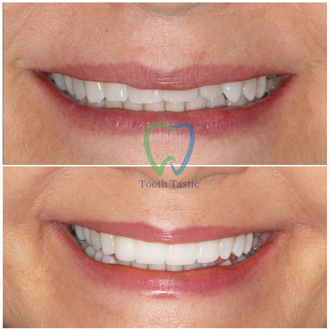veneers before after