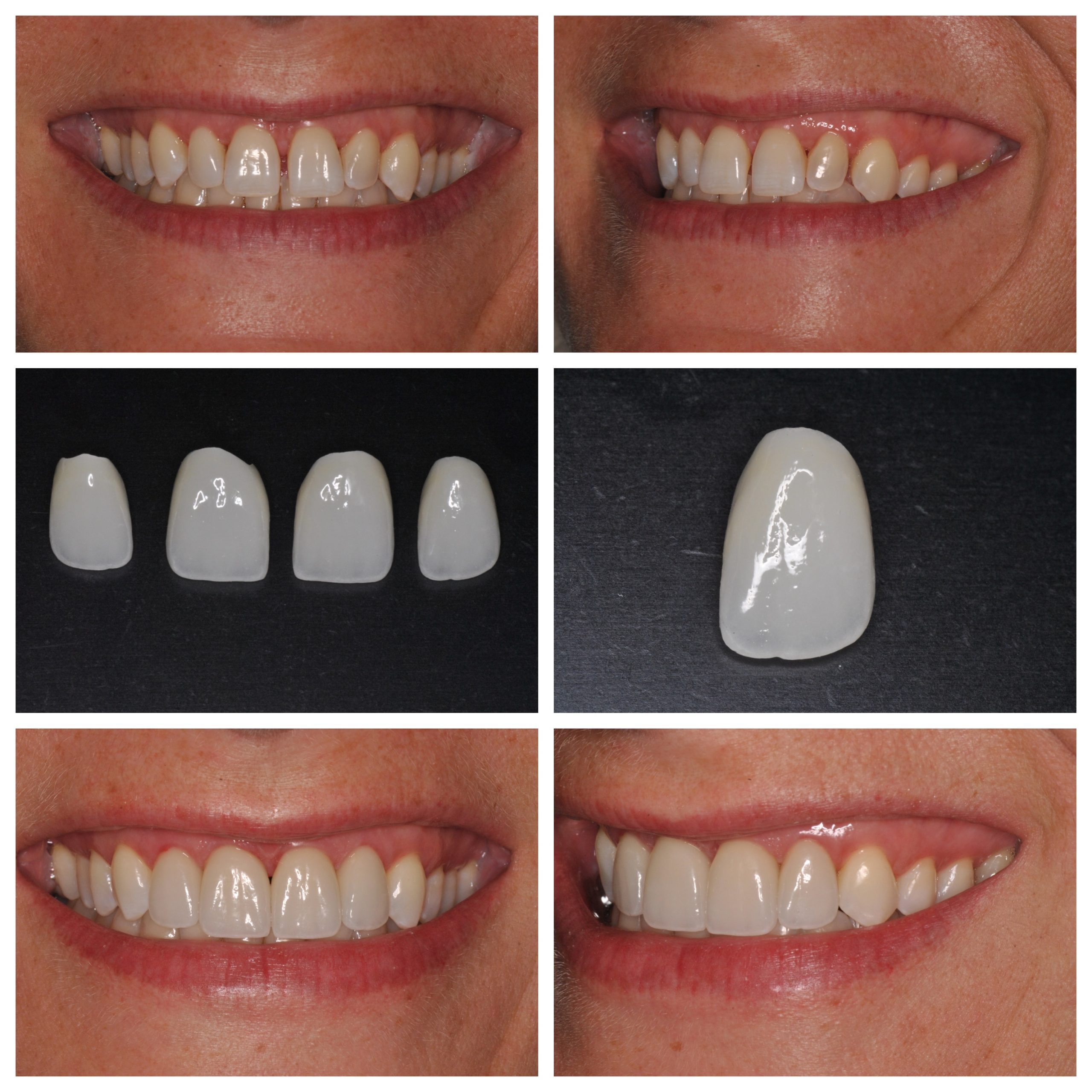 dental veneers before and after comparison