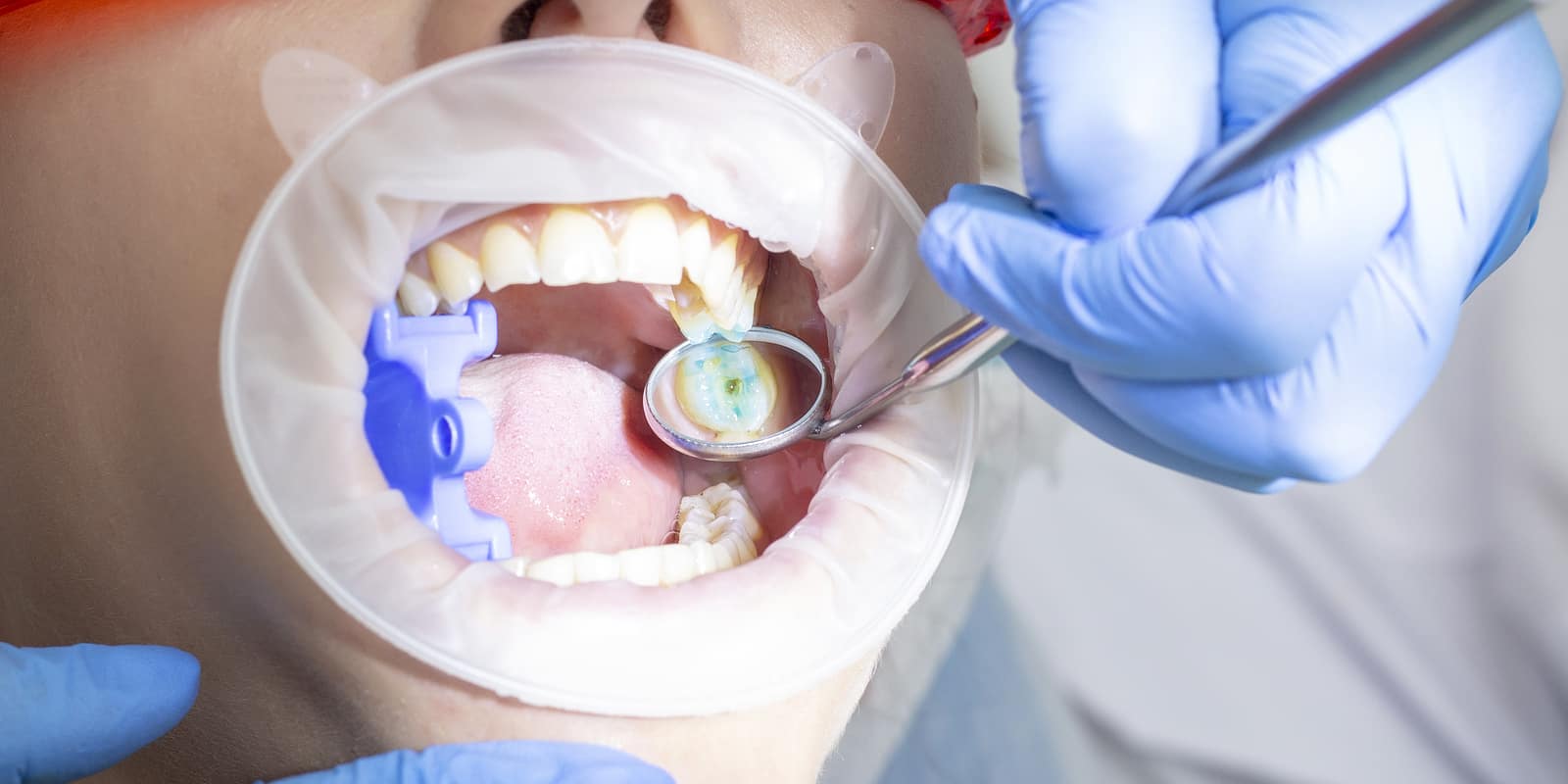 Wisdom tooth extraction Dubai