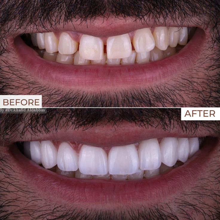 Smile makeover Dubai
