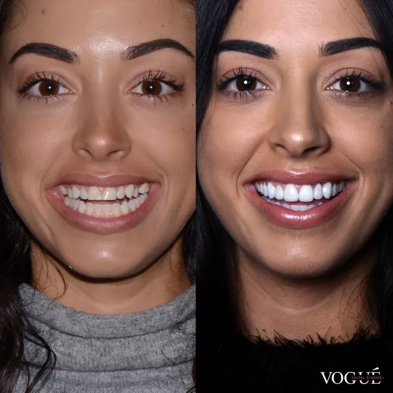 Smile makeover Dubai