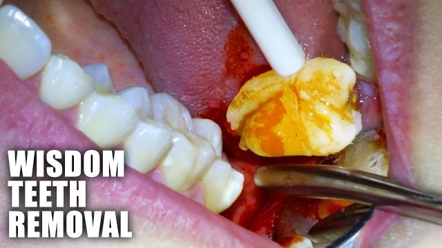 Wisdom tooth extraction Dubai