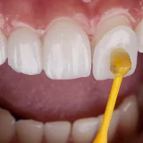 placing a dental veneer on prepared tooth” | Embed under FAQ #4
