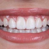 smile with veneers Dubai