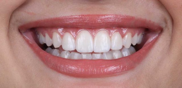 smile with veneers Dubai