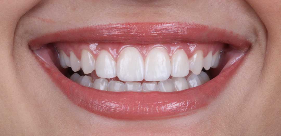 Hollywood Smile Dubai | Transform Your Smile at Tooth Tastic Dental Clinic